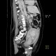 Hypoplasia of inferior vena cava, shunting by hemiazygous vein and vertebral veins: CT - Computed tomography